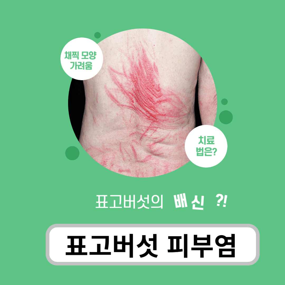 표고버섯피부염