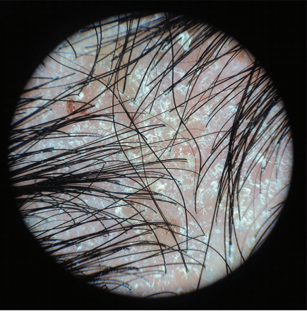 중증 두피 지루성 피부염_ moderate Scalp Seborrheic Dermatitis