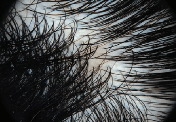 경증 두피 지루성 피부염_ mild Scalp Seborrheic Dermatitis