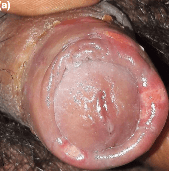 연성하감 궤양 chancroid ulcers
