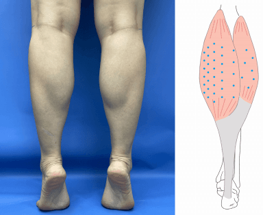 종아리 알 유형 Type of Gastrocnemius muscle hypertrophy