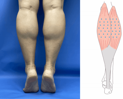 종아리 알 유형 Type of Gastrocnemius muscle hypertrophy