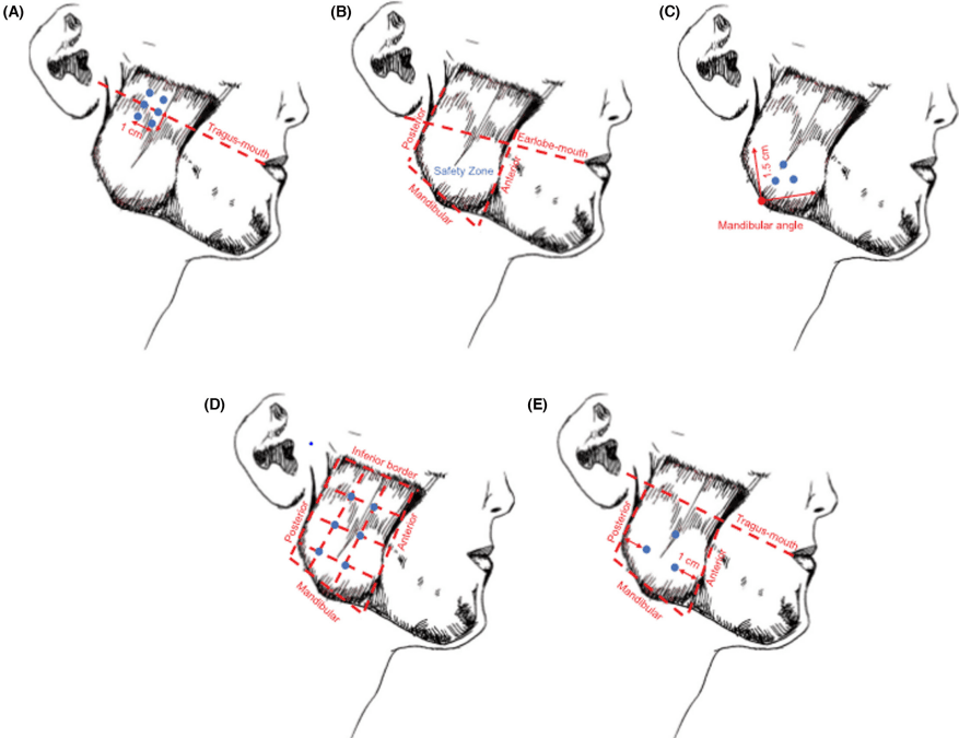 Injection points for masseter botox