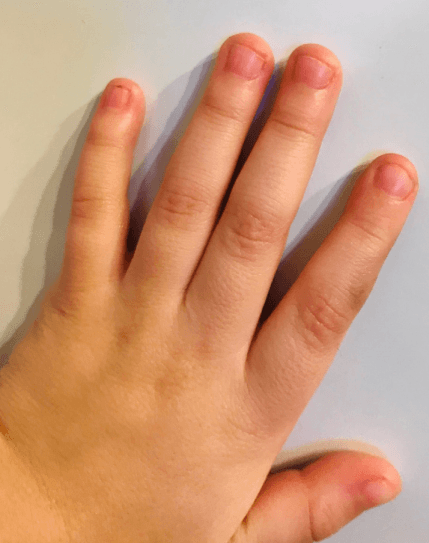 손톱 물어 뜯기 children nail biting, Onychophagia